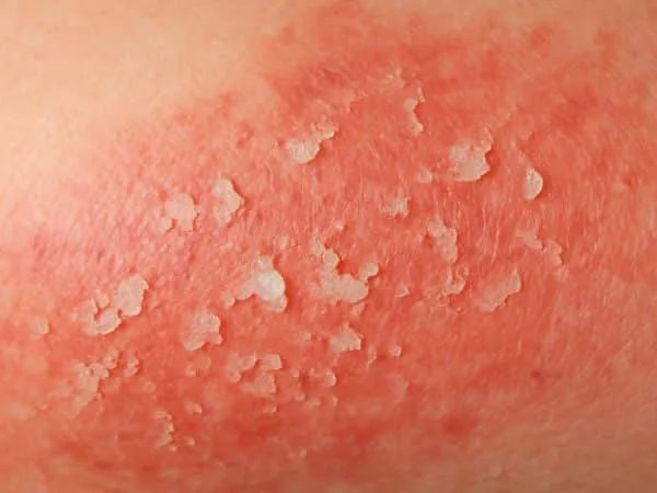 effetto di un farmaco fotosensibilizzante sulla pelle