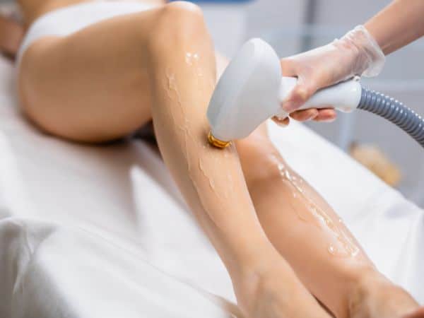 epilazione gambe con luce pulsata su una donna