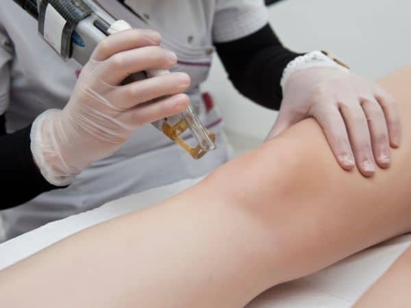 epilazione laser su gamba