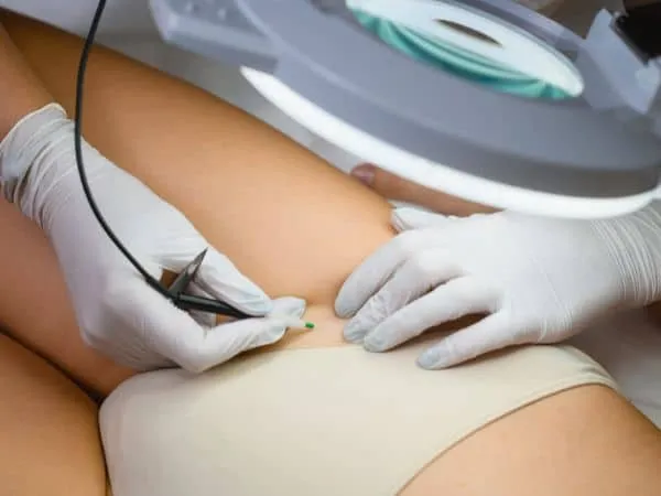 epilazione senza laser con elettrolisi