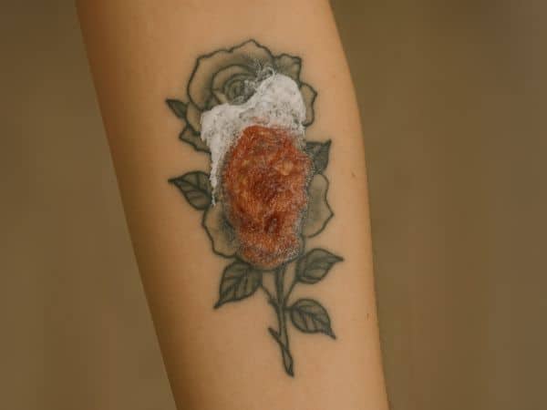 grave ustione su tatuaggio per epilazione laser