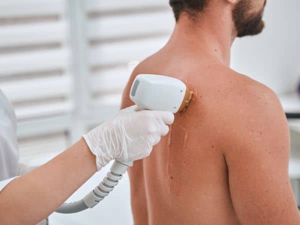laser epilazione su uomo