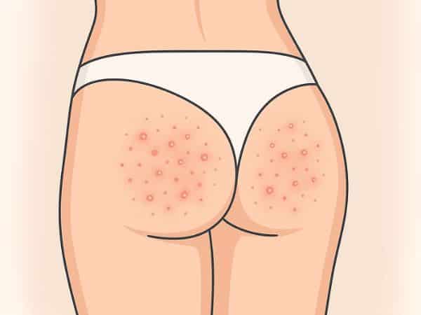 follicolite per peli glutei post depilazione