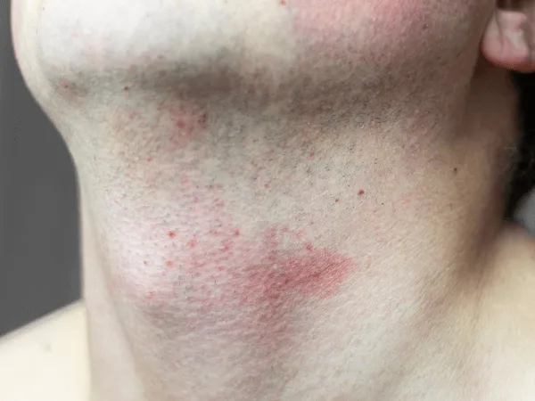 Trattamento laser peli sul collo uomo