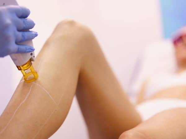 trattamento laser nd yag per epilazione
